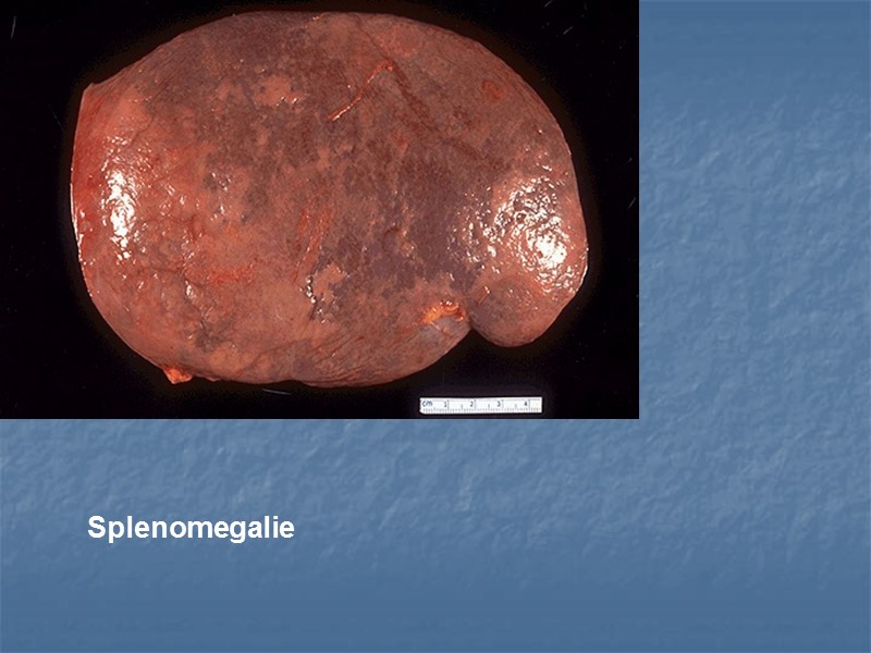 Splenomegalie